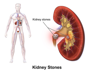 Kidney location and Kidney Stones